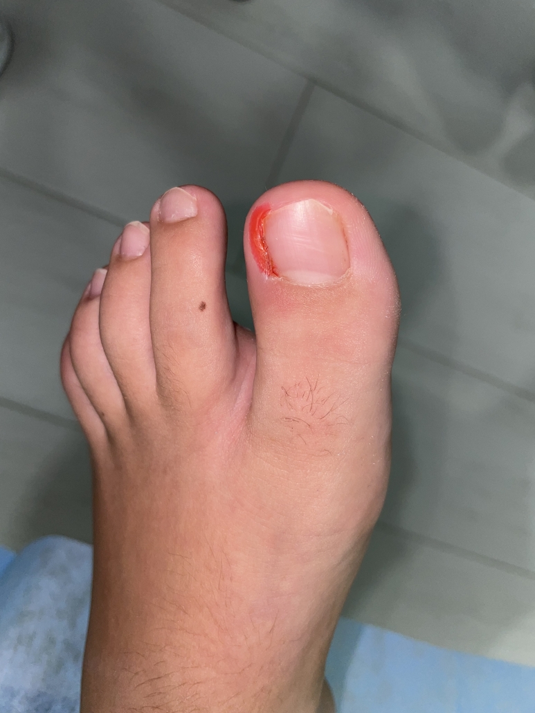 FOOT DOCTORS  Uña Encarnada  Se produce con mayor frecuencia en el  primer dedo del pie que en los demás  Manejamos 3 tipos de  tratamientos para la uña encarnada 